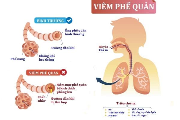 Bé Bị Viêm Phế Quản Thở Khò Khè Mẹ Phải Làm Sao?